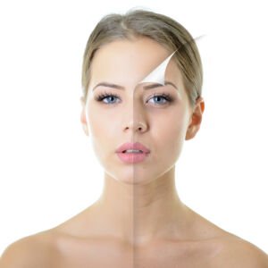 Micro Needling – MRF