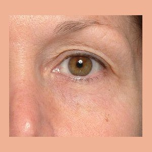 Vorher